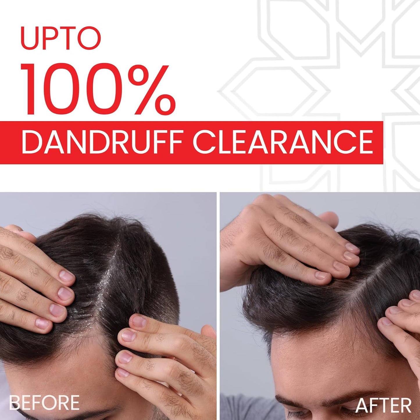 Lupizol-ZS Anti-Dandruff Shampoo (100ml)